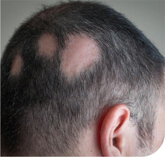 Alopecia Areata